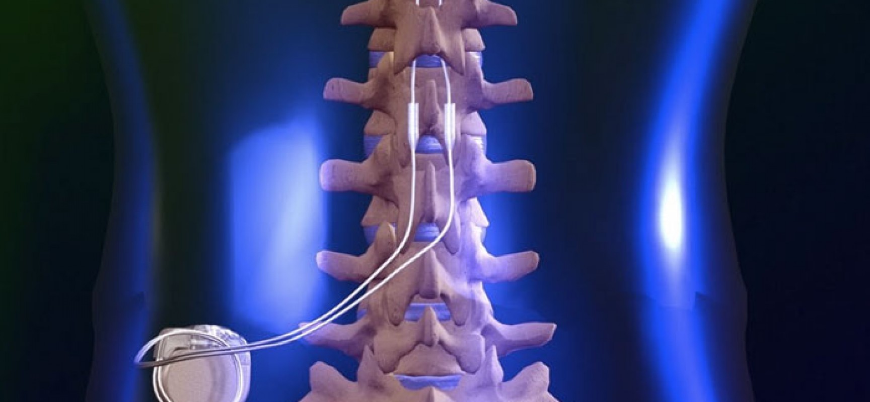 abbott spinal cord stimulator problems