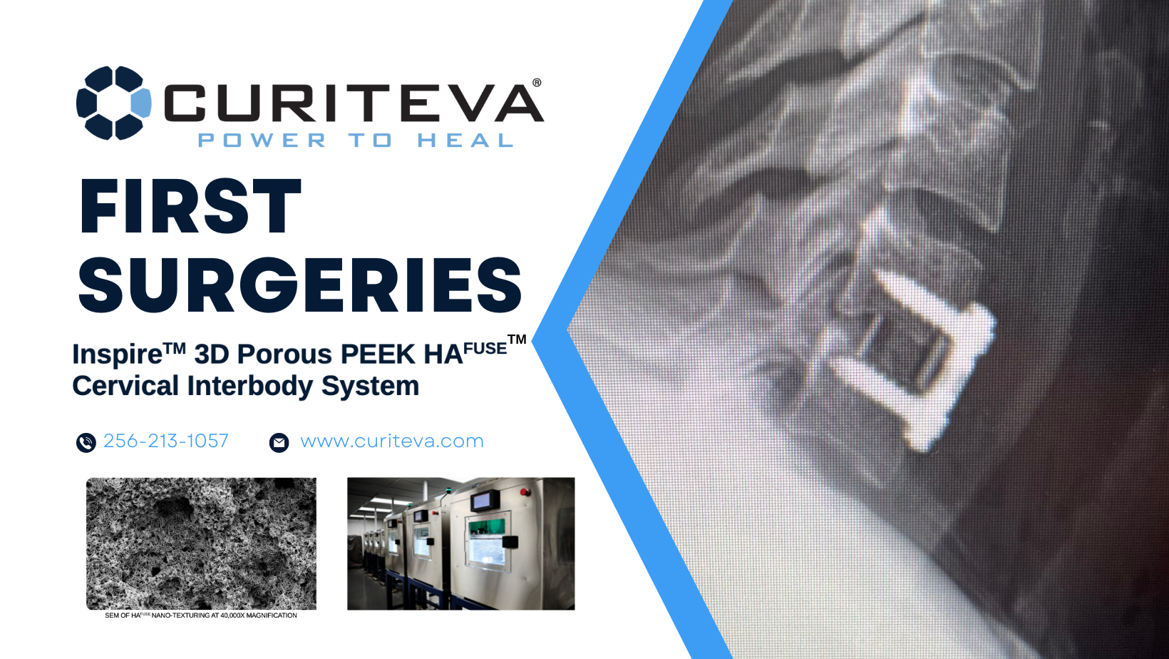 Curiteva Announces First Surgeries Performed With Novel D Printed