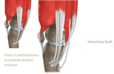 Autografts May Improve ACL Reconstructions - Ortho Spine News