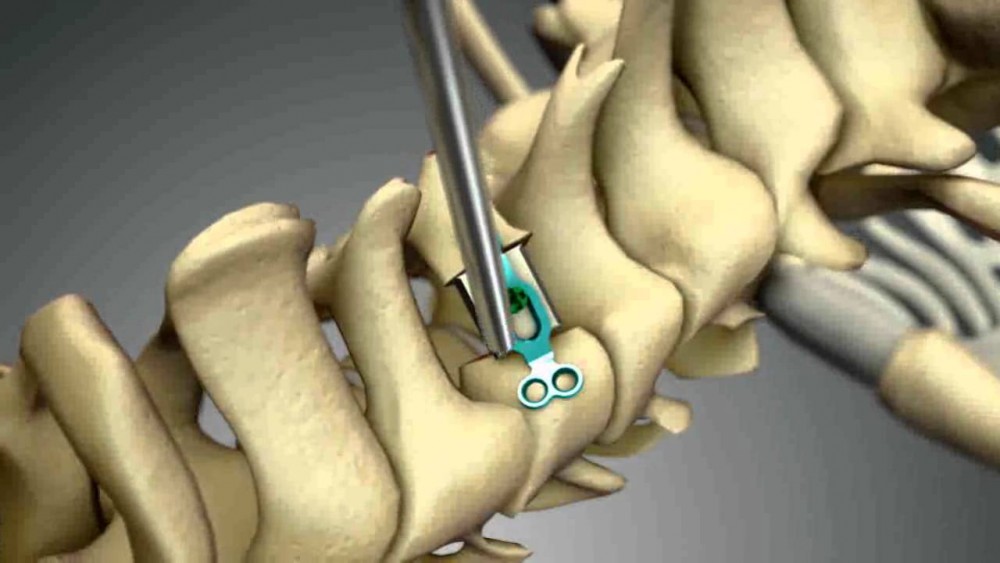 Laminoplasty likely a valid option for spinal cord decompression ...