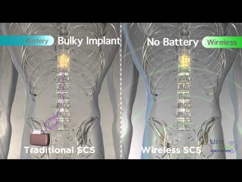 Spinal Cord Stimulation Therapy  Tarpon Interventional Pain & Spine Care