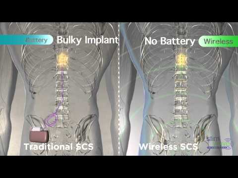 Stimwave, Peripheral Nerve Stimulation for Chronic Pain — Advanced  Diagnostic Pain Treatment Centers