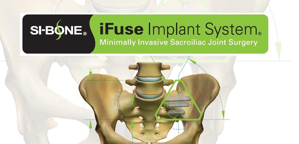 SI-BONE, Inc. Announces Published Guidance Recommendation For Minimally ...