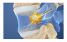 Relievant Announces First Commercial Intracept Procedures - Ortho Spine ...