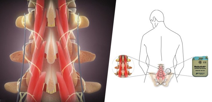 ReActiv8 – Restorative Nerve Stimulation for Back Pain