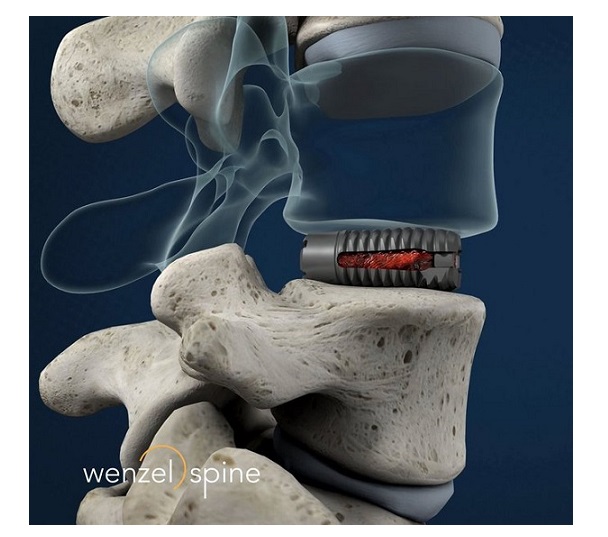 Wenzel Spine Announces First Awake Spinal Fusion Using VariLift 