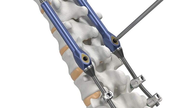 Globus Medical Announces Launch of the MARVEL™ Growing Rod System, the ...