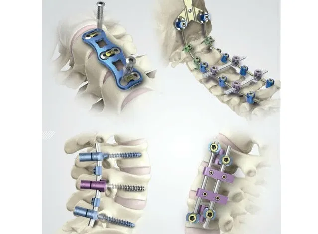 Spinal Implants Market is Expected to Reach $14.3 Billion | MarketsandMarkets™ - Ortho Spine News