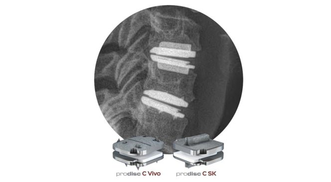 Two Level Disc Replacement Centinel Spine® Receives Two-Level FDA Approval for prodisc® C Vivo and ...